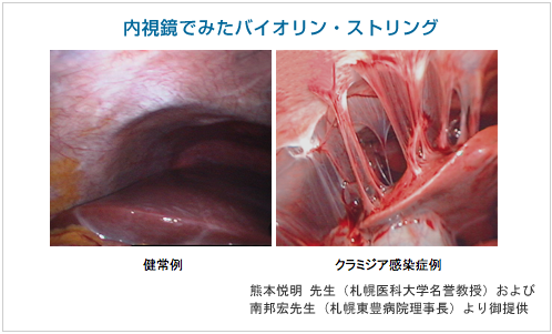 クラミジア症状写真